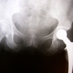 preventing hip fracture hip replacement