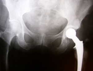 minimally invasive hip replacement