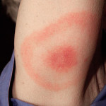 Lyme disease symptoms. This rash is classic.